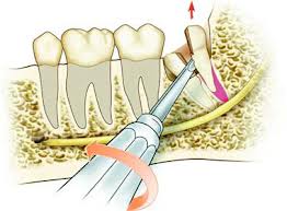anchiloza dento alveolara